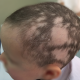 "alopecia areata bambino"