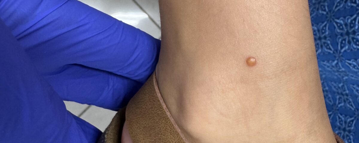 SECONDO CASO Xantogranuloma giovanile: due casi clinici a confronto. Dalla diagnosi clinica alla dermoscopia.