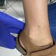 SECONDO CASO Xantogranuloma giovanile: due casi clinici a confronto. Dalla diagnosi clinica alla dermoscopia.